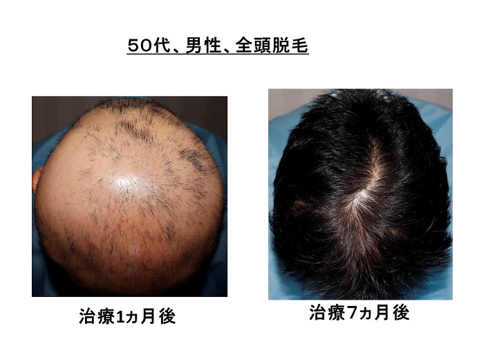 円形脱毛症　病院